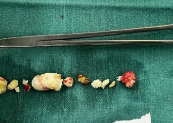 भोपाल BMHRC में जटिल सर्जरी कर महिला के पैन्क्रियाज से निकाले 15 से अधिक स्टोन… इतने बड़े पत्थर देखकर डॉक्टर भी रह गए हैरान