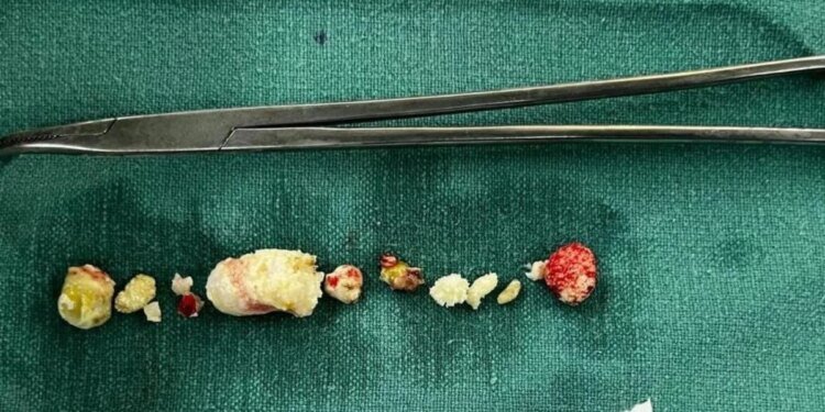 भोपाल BMHRC में जटिल सर्जरी कर महिला के पैन्क्रियाज से निकाले 15 से अधिक स्टोन… इतने बड़े पत्थर देखकर डॉक्टर भी रह गए हैरान