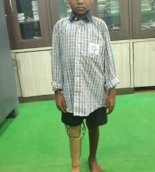 10 साल के कमलेश को मिला कृत्रिम पैर, अब मंजिल की ओर बढ़ेंगे कदम