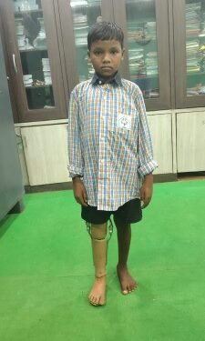 10 साल के कमलेश को मिला कृत्रिम पैर, अब मंजिल की ओर बढ़ेंगे कदम