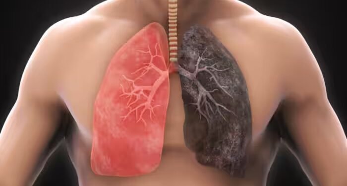 पहले सालों तक स्मोकिंग की, अब सही करने हैं फेफड़े? डॉ. विकास मित्तल ने बताया रिकवरी का पैंतरा